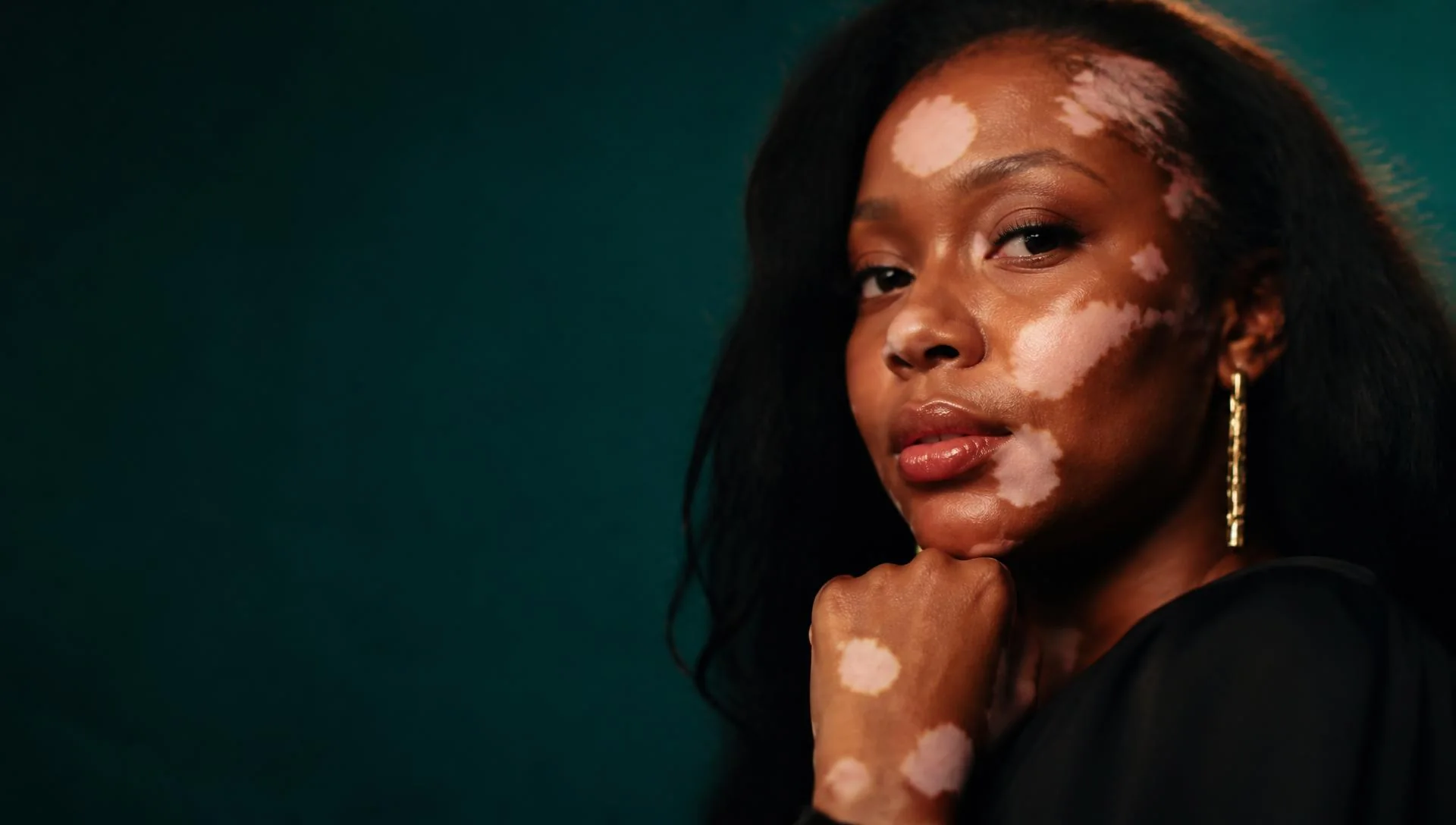 Retrato de mulher com vitiligo, olhar confiante em luz cinematográfica